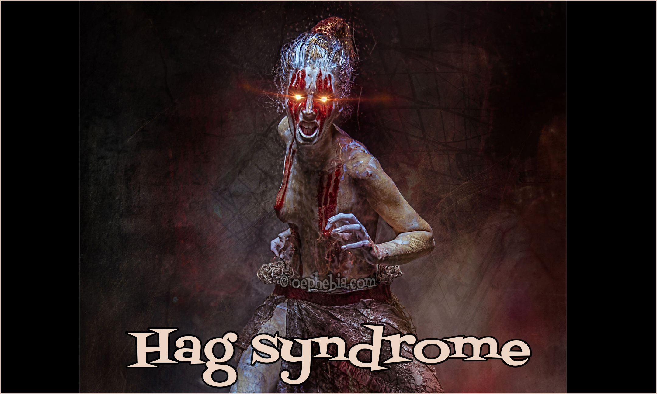 hag syndrome